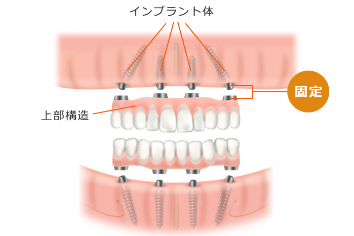 オールオン4の構造