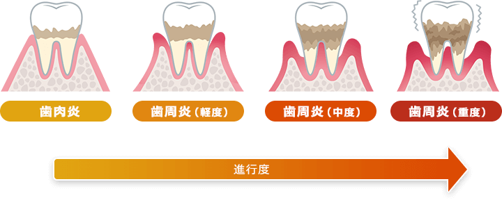 歯周病の進行